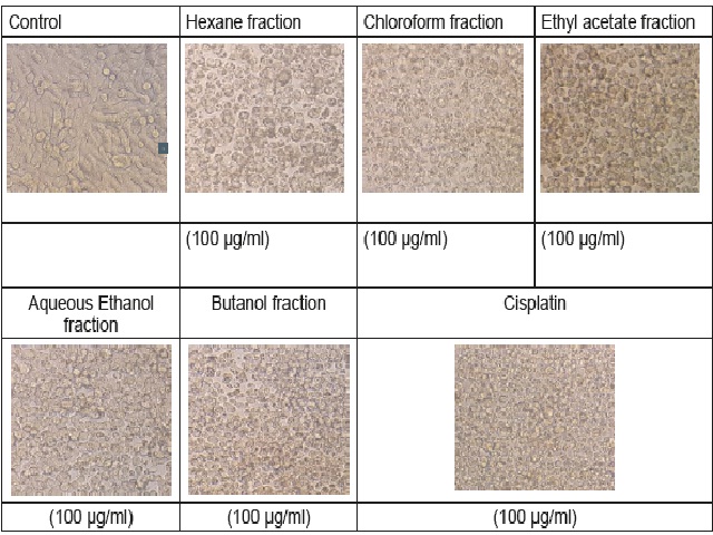 Phase contrast microscopic images of A375 melanoma cells. In control cells distinct morphology was observed. In treated cells, distorted cell morphology was observed.