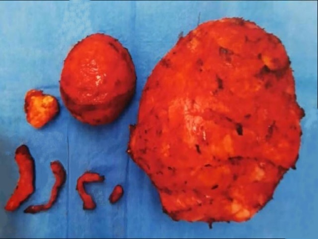 shows the different sizes of fibroids removed from a women